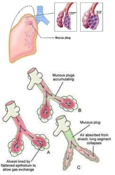 inflamacija disajnih puteva