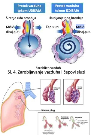 Zarobljeni vazduh cepovi sluzi 