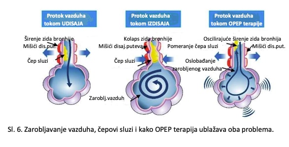 AirPhysio zarobljeni vazduh OPEP terapija
