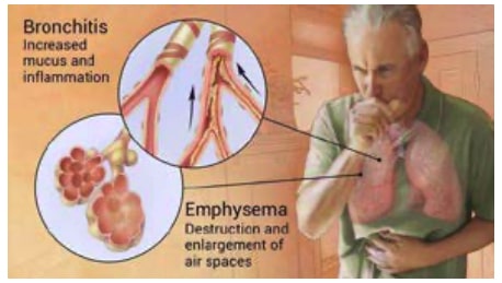 Hronicne opstruktivne bolesti pluca